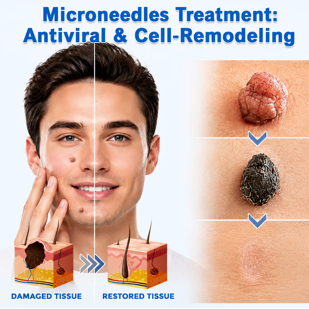 ✨𝐇𝐢𝐬𝐤𝐢𝐧® 2-in-1 Microneedle & Hydrocolloid Patch🍀 | Removes raised moles, acne, flat warts, and skin tags | Helps improve wrinkles, scars, and blemishes | Invisible patches for face and body