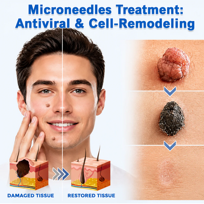 ✨𝐇𝐢𝐬𝐤𝐢𝐧® 2-in-1 Microneedle & Hydrocolloid Patch🍀 | Removes raised moles, acne, flat warts, and skin tags | Helps improve wrinkles, scars, and blemishes | Invisible patches for face and body