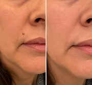 ✨𝐇𝐢𝐬𝐤𝐢𝐧® 2-in-1 Microneedle & Hydrocolloid Patch🍀 | Removes raised moles, acne, flat warts, and skin tags | Helps improve wrinkles, scars, and blemishes | Invisible patches for face and body