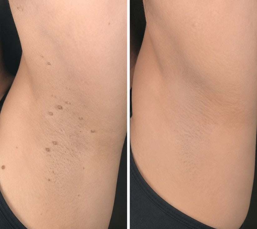 ✨𝐇𝐢𝐬𝐤𝐢𝐧® 2-in-1 Microneedle & Hydrocolloid Patch🍀 | Removes raised moles, acne, flat warts, and skin tags | Helps improve wrinkles, scars, and blemishes | Invisible patches for face and body