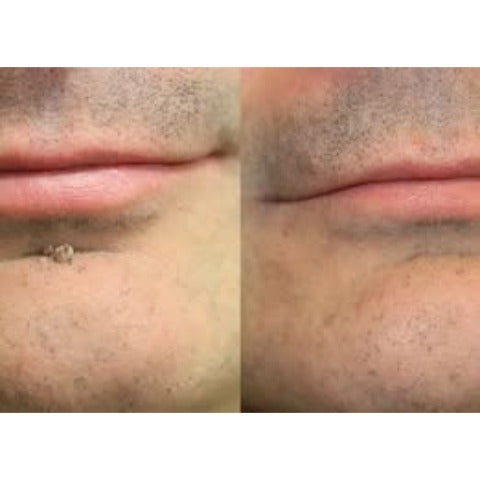✨𝐇𝐢𝐬𝐤𝐢𝐧® 2-in-1 Microneedle & Hydrocolloid Patch🍀 | Removes raised moles, acne, flat warts, and skin tags | Helps improve wrinkles, scars, and blemishes | Invisible patches for face and body