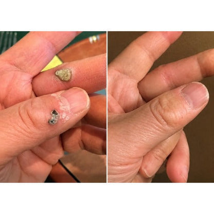 ✨𝐇𝐢𝐬𝐤𝐢𝐧® 2-in-1 Microneedle & Hydrocolloid Patch🍀 | Removes raised moles, acne, flat warts, and skin tags | Helps improve wrinkles, scars, and blemishes | Invisible patches for face and body