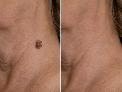 ✨𝐇𝐢𝐬𝐤𝐢𝐧® 2-in-1 Microneedle & Hydrocolloid Patch🍀 | Removes raised moles, acne, flat warts, and skin tags | Helps improve wrinkles, scars, and blemishes | Invisible patches for face and body