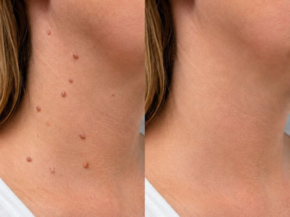 ✨𝐇𝐢𝐬𝐤𝐢𝐧® 2-in-1 Microneedle & Hydrocolloid Patch🍀 | Removes raised moles, acne, flat warts, and skin tags | Helps improve wrinkles, scars, and blemishes | Invisible patches for face and body