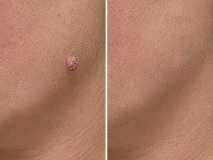 ✨𝐇𝐢𝐬𝐤𝐢𝐧® 2-in-1 Microneedle & Hydrocolloid Patch🍀 | Removes raised moles, acne, flat warts, and skin tags | Helps improve wrinkles, scars, and blemishes | Invisible patches for face and body